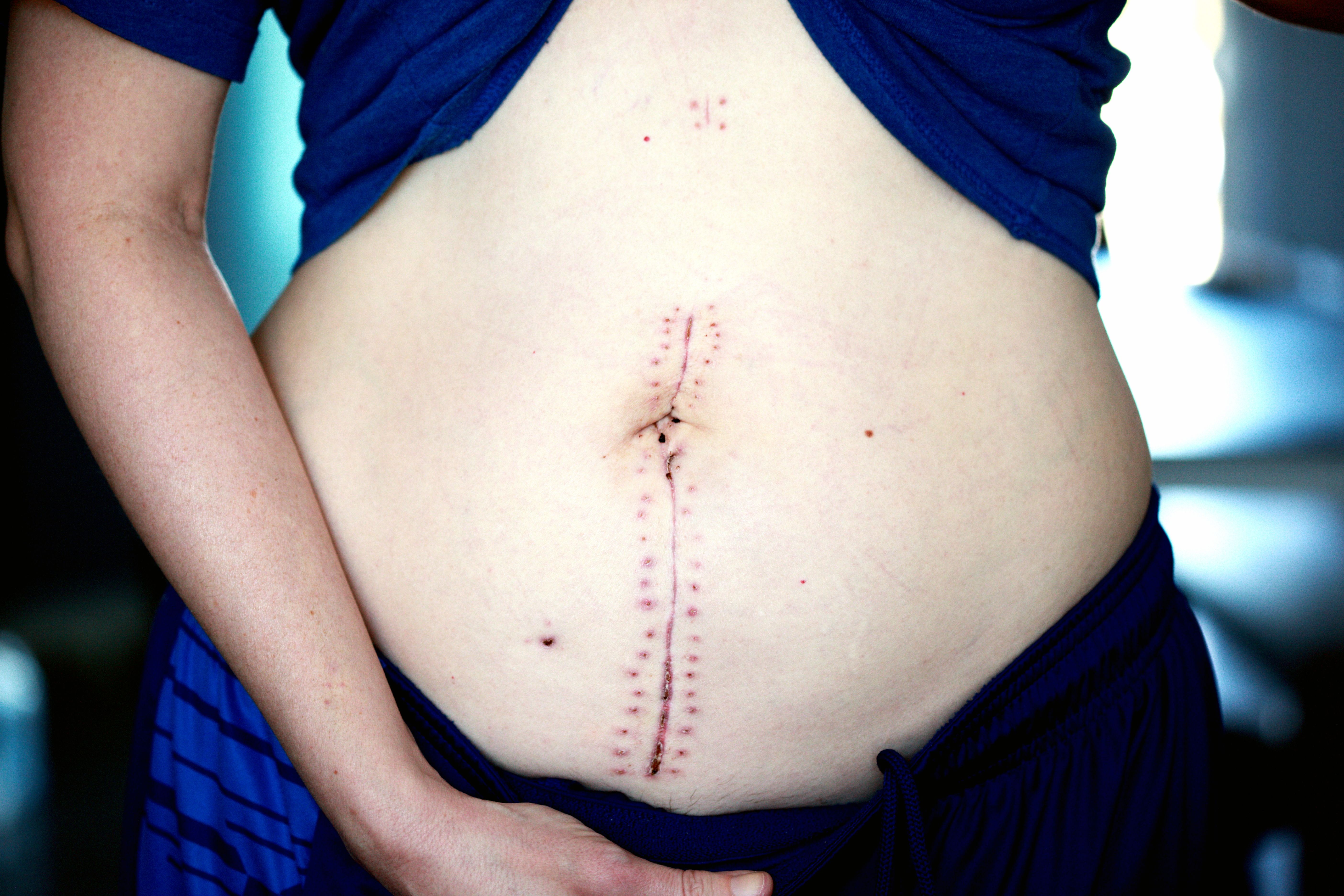 Laparoscopic ovarian cyst surgery consultation