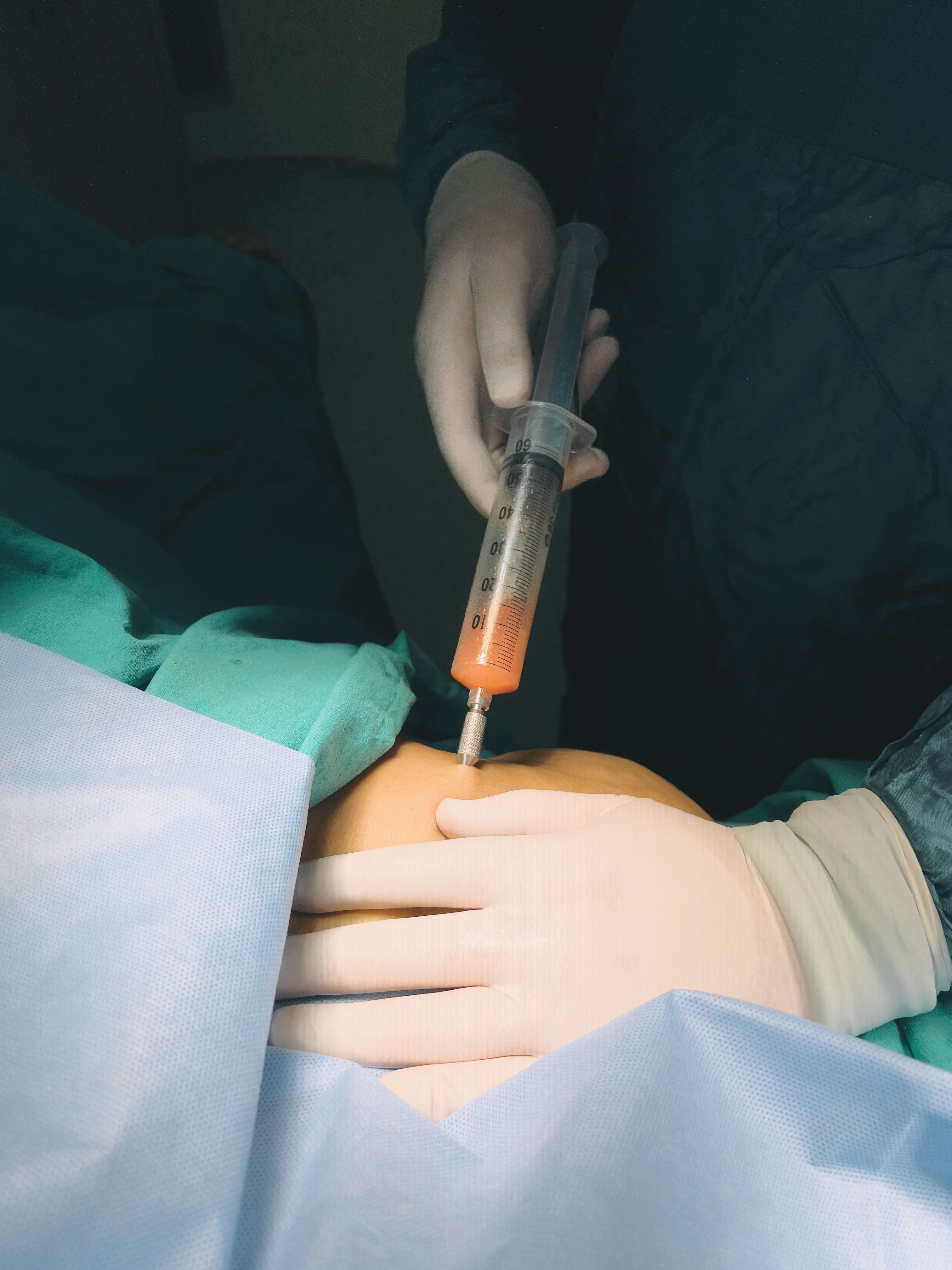 Hysteroscopic fibroid removal consultation